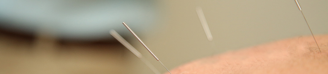 Acupuncture Pins
